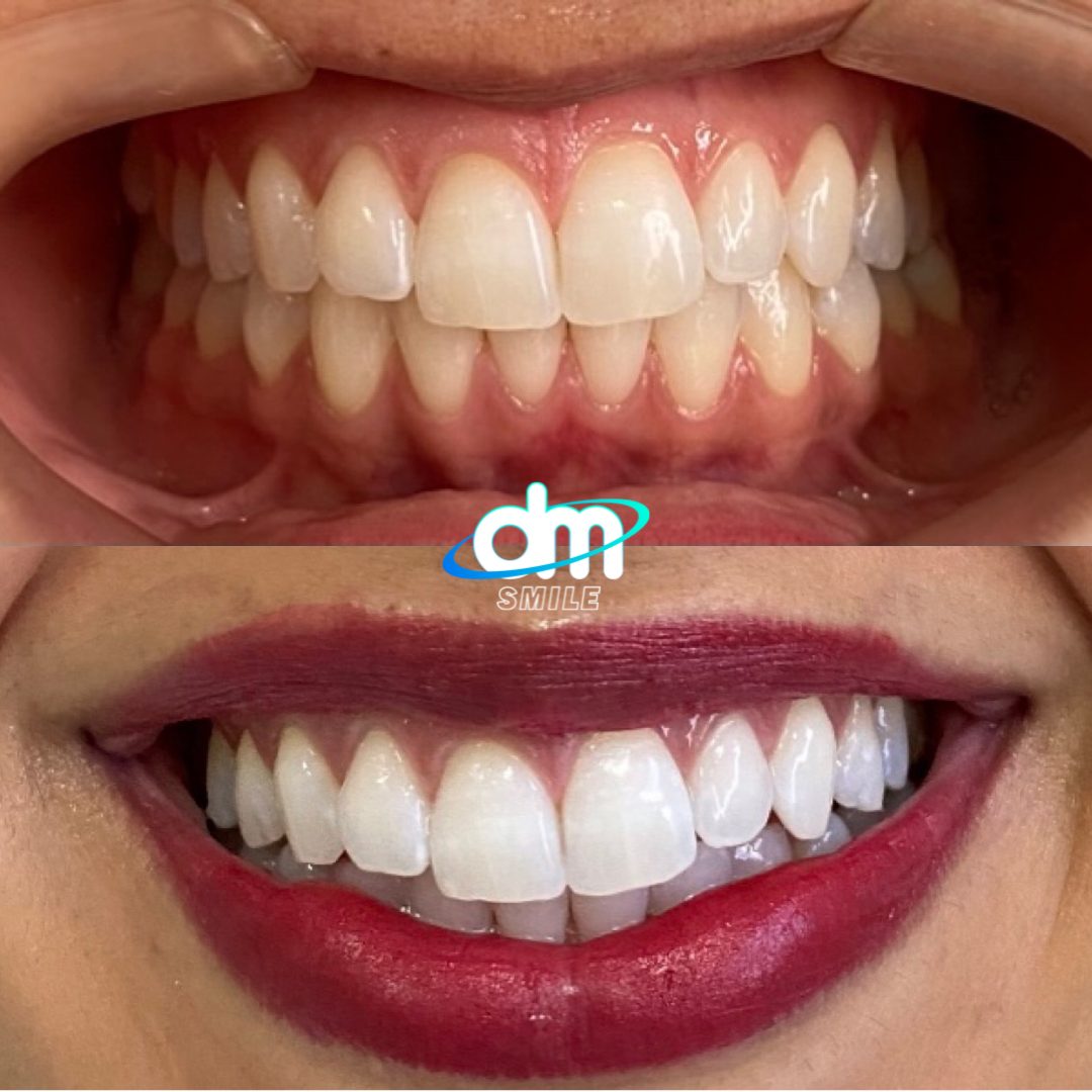 Antes e depois de clareamento dental realizado na DM Smile